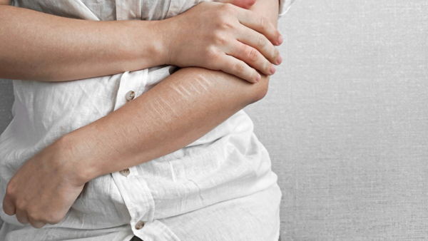 Assessing & Treating Non-Suicidal Self-Injury